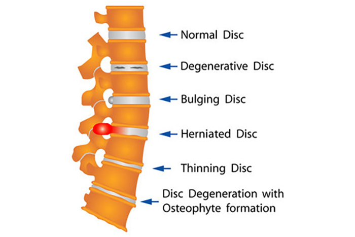 Can PRP Therapy Help Patients With Degenerative Disc Disease?